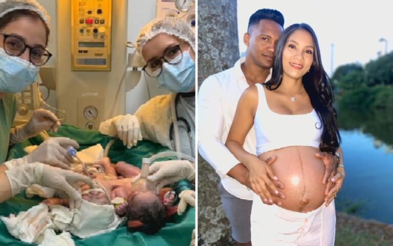 Bebês siameses unidos pelo abdômen nascem em Goiânia bebes-siameses-unidos-pelo-abdomen-nascem-em-goiania